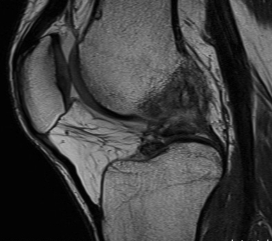 MRI Proton Density